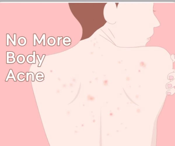 img_1174 TIAM ANTI تيام لوشن مرطب جسم لعلاج اثار حبوب الجسم